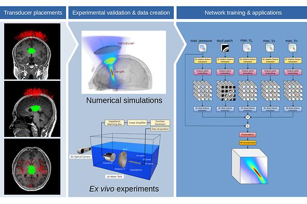 An AI Technology for Brain Stimulation Therapy Developed